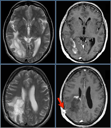 The Radiology Assistant : Multiple Sclerosis