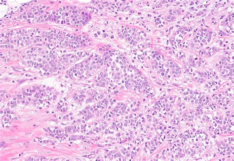 Invasive Lobular Carcinoma