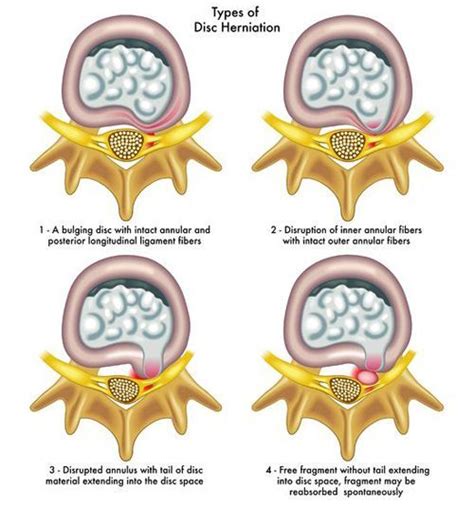 What Are The Differences Between A Herniated Disc Protrusion And Disc | Images and Photos finder