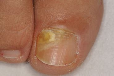 Proximal Subungual Onychomycosis | SpringerLink