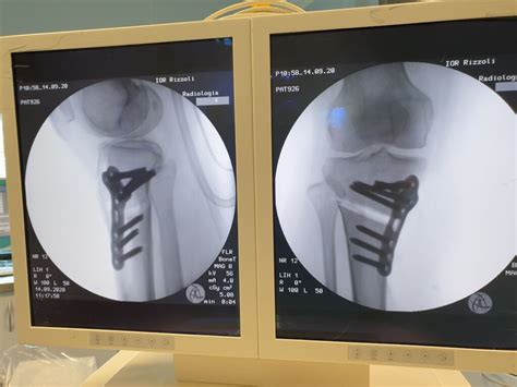 Understanding the Benefits and Risks of High Tibial Osteotomy - Orthoscape