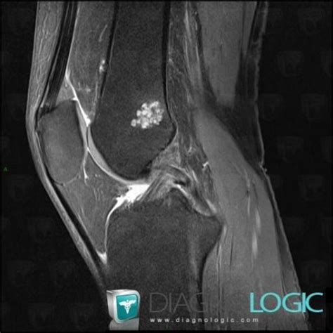 Radiology case : Enchondroma (MRI) - Diagnologic