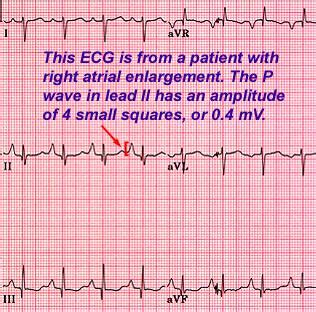 Step 5: Inspect P waves for atrial enlargement