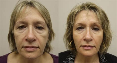 Face Filler For Marionette Lines Before and After