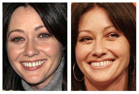 Plastic Surgery Before After: Shannen Doherty Plastic Surgery