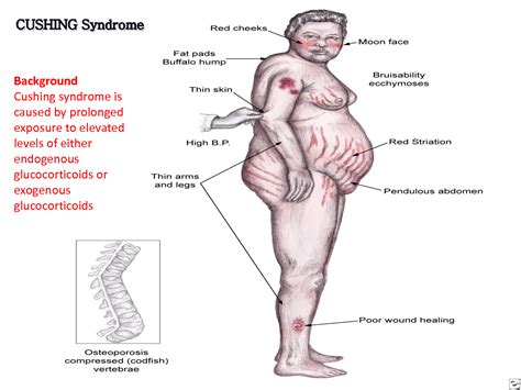 Cushing's Syndrome : Signs and symptoms of Cushing's syndrome