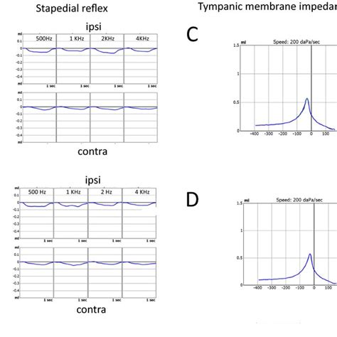 Stapedial reflex (a, b) and tympanic membrane impedance (c, d) measured ...