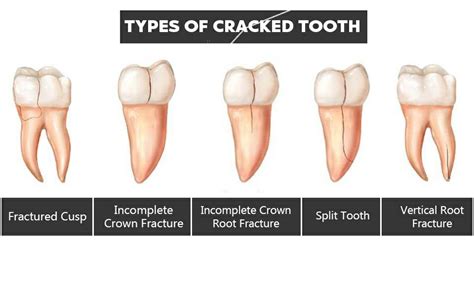 Tooth Fracture - Types | Causes | Symptoms | Diagnosis | Treatment