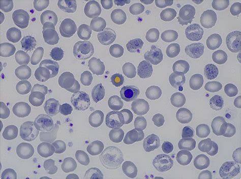 Reticulocyte Vs Heinz Body