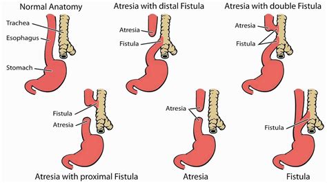 Esophageal atresia & tracheoesophageal fistula causes, symptoms & treatment