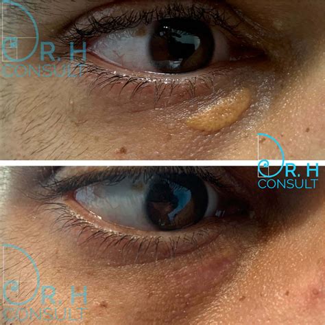 Surgery Xanthelasma Before And After