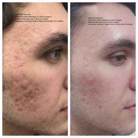 Acne Scar Laser Treatment & Removal London | Dr H Consult