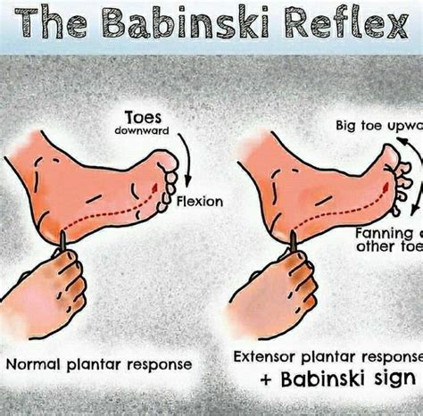 The babinski reflex | Nursing study, Nursing school studying, Nurse humor