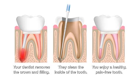 How Long Does a Root Canal Take - Nashville, TN - Gulch Dental Studio