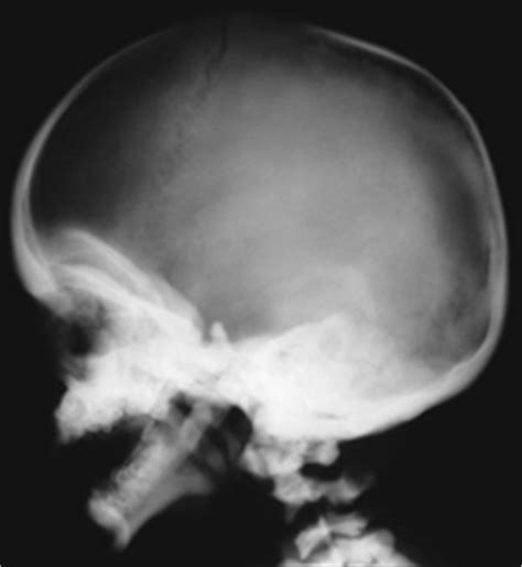 116 Osteopetrosis | Radiology Key