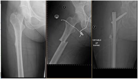 Atypical femur fractures: current understanding and approach to management - Lianne Tile, Angela ...