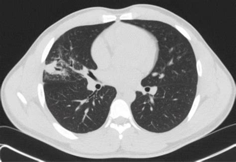 CT scan showing post-obstructive pneumonia. | Download Scientific Diagram