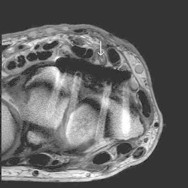 MRI showing FPL rupture (white arrow) and close proximity of the flexor... | Download Scientific ...