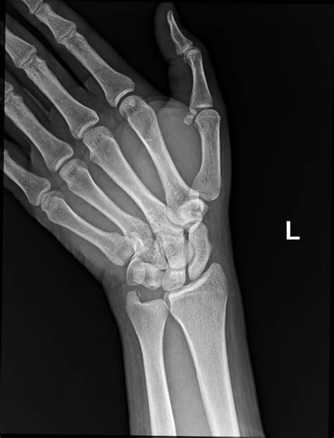 Avulsion Fracture Of Styloid Process Of Ulna