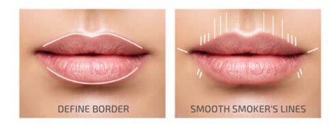 Kiss Thin Lips Goodbye With Restylane® KYSSE™ - Skin Artisans