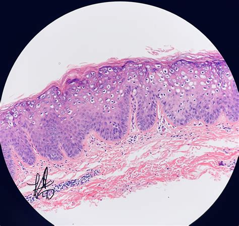 Filiform Wart Histology