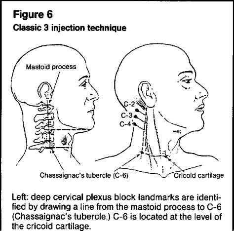 Superficial Cervical Plexus Block