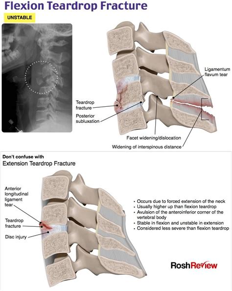 Flexion Teardrop Fracture | Emergency medicine, Medical laboratory science, Diagnostic medical ...