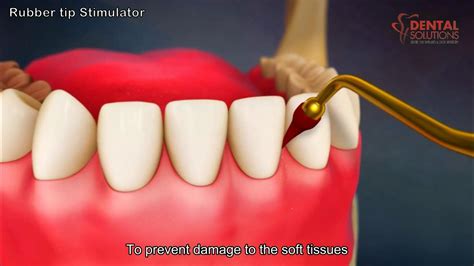 How to use a rubber tip Gum Stimulator work - 3d animation video - Dental Solutions Clinic ...