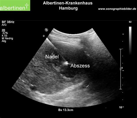 Abscess punction, liver ultrasound - DocCheck