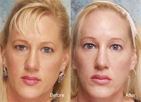 Eyelid Case Study | Beverly Hills Blepharoplasty Cases