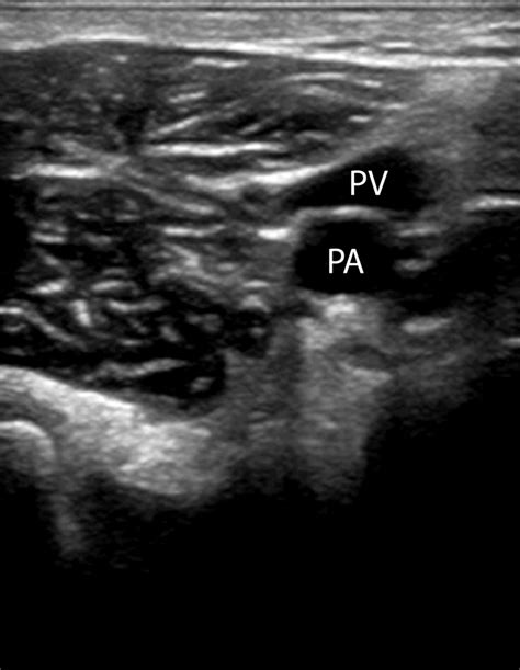 Peroneal Vein Ultrasound