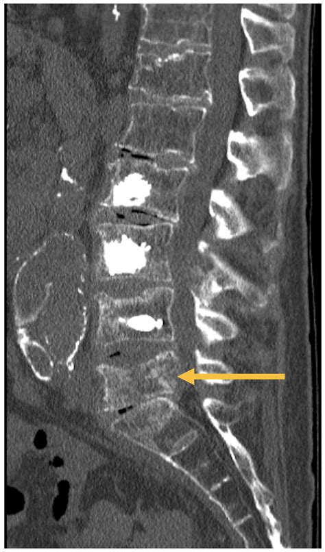 Cureus | Image-guided Percutaneous Polymethylmethacrylate-augmented Spondylodesis for Painful ...