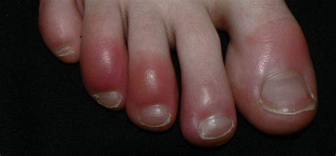 Chilblains Symptoms, Causes And Treatment Home Remedies