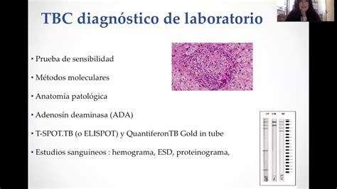 Tuberculosis diagnostico y tratamiento - YouTube