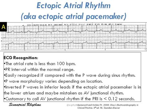 Multifocal Atrial Rhythm vs Wandering Atrial Pacemaker Mutifocal Atrial Rhythm / Multifocal ...