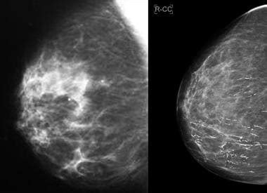 Breast Cancer Digital Mammogram