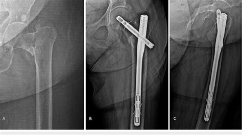 (A) Radiograph of a two-part basicervical fracture in an 86-year-old ...