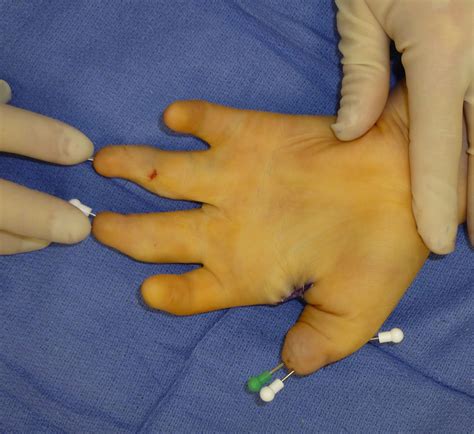 Carpenter Syndrome | Congenital Hand and Arm Differences | Washington University in St. Louis