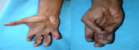 Degloving Injury of Palm & Digits