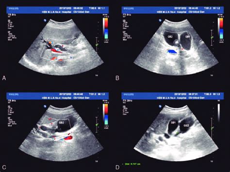 Ultrasound manifestation of the patient. (A-C) Ultrasound results ...