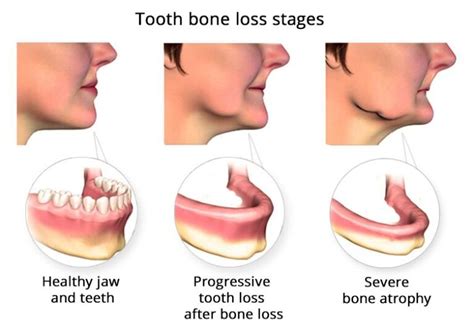 Tooth Bone Loss? | LuxDen Dental Implants Center in Brooklyn NY