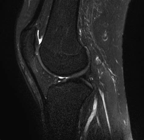 Normal knee MRI | Radiology Case | Radiopaedia.org | Knee mri, Mri, Radiology