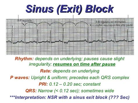 Sinus Rhythms - BMH/Tele