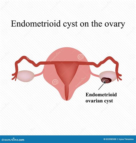 Endometrioid Cartoons, Illustrations & Vector Stock Images - 31 ...