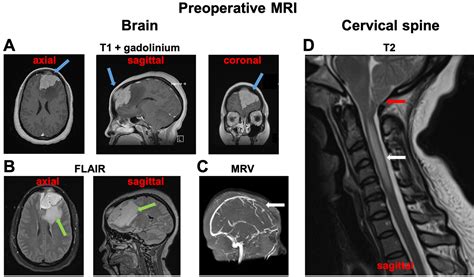 Cureus | Resolution of Tonsillar Herniation and Syringomyelia Following Resection of a Large ...