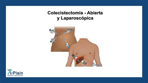 Colecistectomía - Abierta y laparoscópica - YouTube