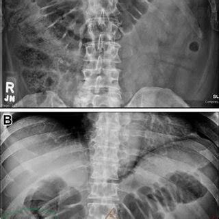 Sentinel Loop Sign In Pancreatitis : The presence of calcifications ...