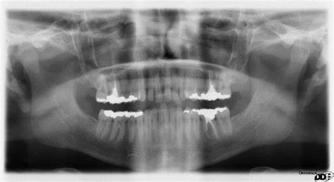 Panoramic radiograph - Alchetron, The Free Social Encyclopedia