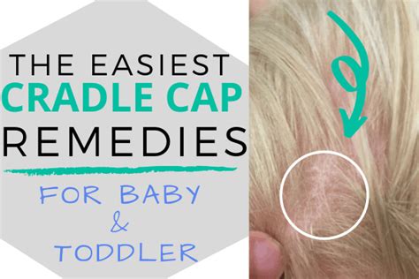 Cradle Cap: Home Remedies to Get Rid of It! – Oh Baby Love