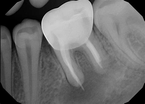 Dental X-Rays: The Whole Tooth – Pediatric Dental Blog